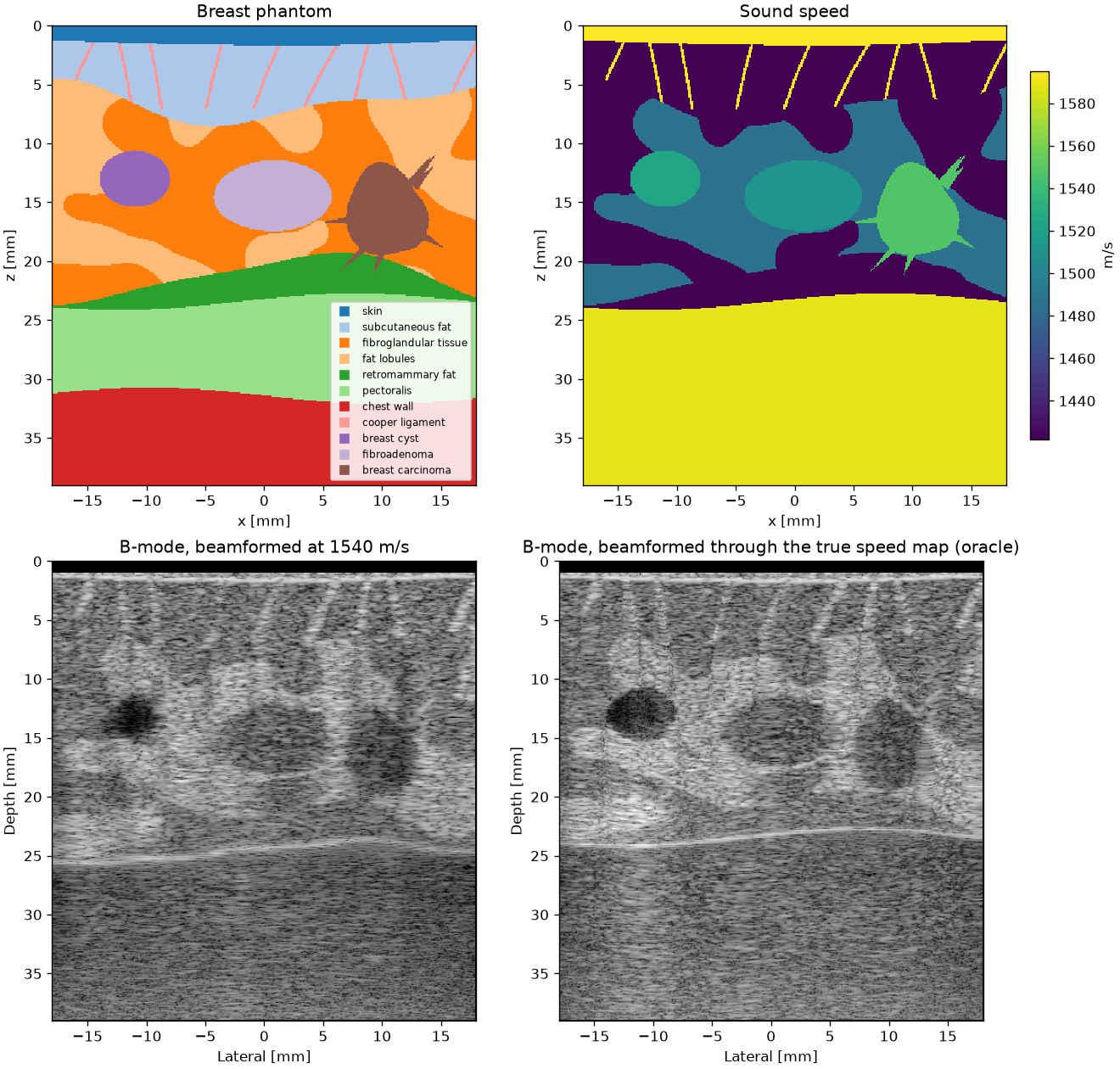 Breast phantom labels, sound speed map, and B-mode images beamformed at 1540 m/s and through the speed map