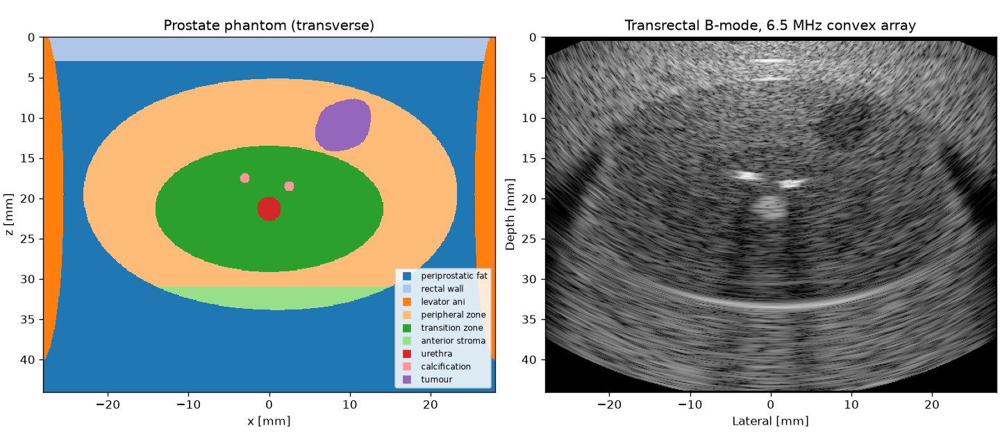 Prostate phantom labels and transrectal sector image with a peripheral zone tumour and calcifications