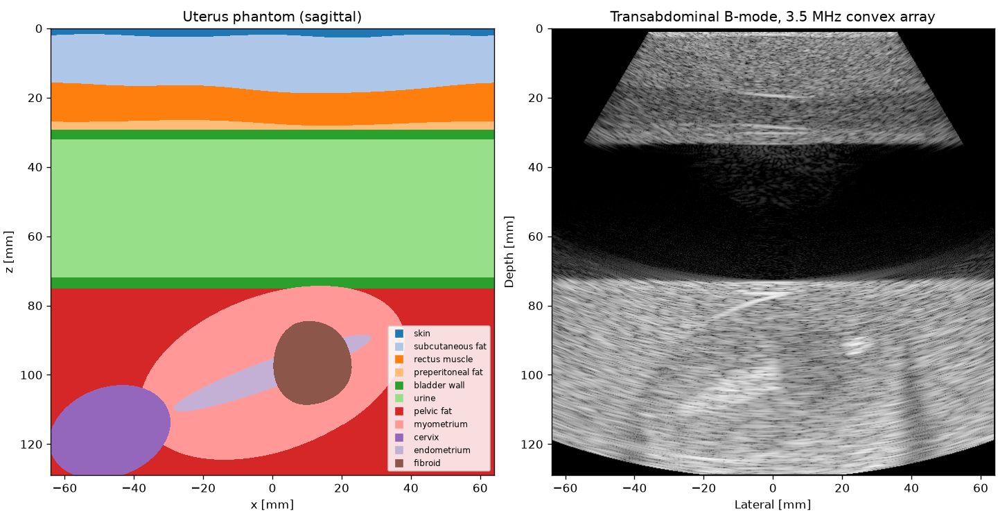 Uterus phantom labels and transabdominal sector image with a fibroid behind the full bladder